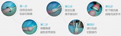 DCSD纳米包皮吻合术